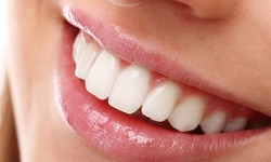 Why Teeth Whitening is best done by the Dentist