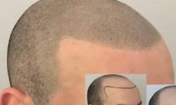 Developing Your Career With Courses In Scalp Micropigmentation: Know Here
