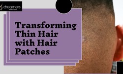 Hair Replacement Solutions at Dreamers Hair Studio in Panchkula, Mohali, and Chandigarh