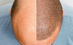 Hair Replacement in Hinjewadi with GrowBrite: Transforming Lives