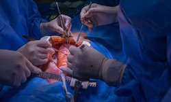 Understanding the Life-Saving Benefits and Techniques of Open-Heart Surgery