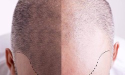 The Art and Science of Hair Transplantation
