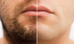 Radiant Results: Beard Laser Hair Removal Abu Dhabi Specialists