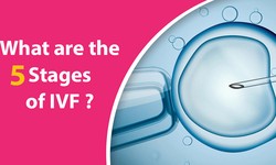 Understanding the 5 Stages of IVF: A Comprehensive Guide