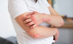 Can Nummular Eczema Be Treated with Homeopathy?