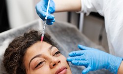 Unlock Radiant Skin: Dive into the World of Microneedling