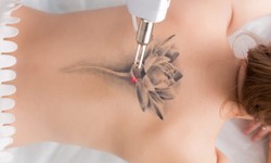 Beyond the Surface: Exploring Permanent Laser Tattoo Removal Technology