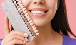Unlock Your Perfect Smile: The Power of Dental Veneers Revealed
