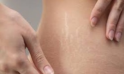 The Miracle of Stretch Mark Removal Laser