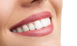 Bright Smiles Await: Teeth Whitening Offers in Sharjah