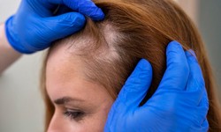 Strand by Strand: Your Guide to Hair Loss Clinics in Dubai