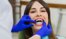 Enhance Your Smile with Top Cosmetic Braces in Miami Explained