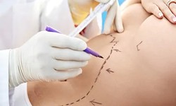 Transforming Lives: The Impact of Perineal Plastic Surgery in Dubai