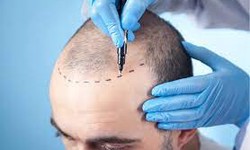 Preparing for DHI Hair Implantation Surgery