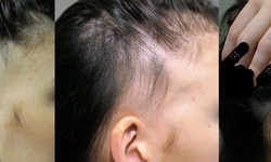 Combat Thinning Hair with Effective Solutions