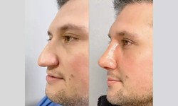 The Masculine Approach: Male Rhinoplasty for a Stronger Profile
