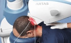 Why Choose Robotic Hair Transplant at Estheticare Clinic?