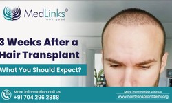 3 Weeks After a Hair Transplant: What You Should Expect?
