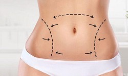 Transform Your Reflection: Liposuction Surgery in Riyadh Revealed