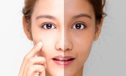 Why Glutathione injection is good for skin whitening?