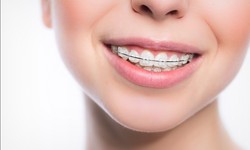 Decoding Braces Costs in Singapore: What to Expect