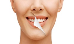 Step-By-Step Guide To Professional Teeth Whitening Services