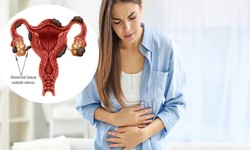 Understanding Endometriosis, Symptoms And Its Treatment Options