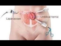 Laparoscopic Umbilical Hernia Surgery in Thane West with Highway Hospital Thane: A Comprehensive Guide