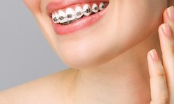 Enhancing Smiles: A Deep Dive into Dental Braces