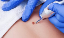 Dubai's Dermatology Revolution: The Future of Mole Removal
