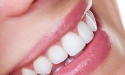 Say Cheese! A Guide to Teeth Whitening Clinics in Dubai