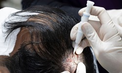 Dubai Delight: Reclaim Your Confidence with PRP Hair Treatment