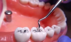 Step-By-Step Guide To Getting A Dental Filling Service In London Ontario