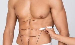 Realistic Expectations: What Liposuction Can and Can’t Do for You in Dubai