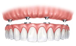 Dental Implant Solutions For Seniors: Your Essential Guide