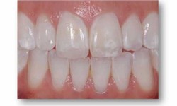 Easy Ways to Get Rid of White Spots on Teeth Naturally