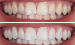 Why You Should Get Your Teeth Whitened by a Dentist