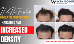 How Hair Transplants Can Help You Achieve Perfect Hairlines and Increased Density