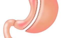 5 Life-Changing Benefits of Gastric Sleeve Surgery You Must Know
