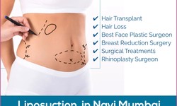 Trimming to Perfection: Exploring Liposuction in Navi Mumbai with Dr. Vinod Vij's 25+ Years of Expertise