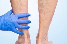 "Varicose Vein Treatment: What to Expect Before, During, and After"