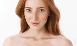 Debunking Myths About Melasma