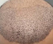 How Long Does It Take for a Hair Transplant to Work?