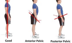 Improving Your Posture with Physiotherapy