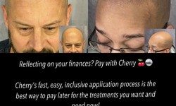 Scalp Micropigmentation: Westerville’s Innovative Hair Loss Solution