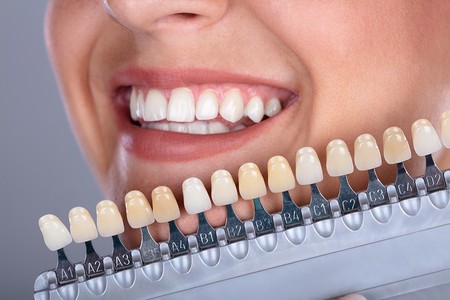 Teeth Whitening for Sensitive Teeth: The Ultimate Guide