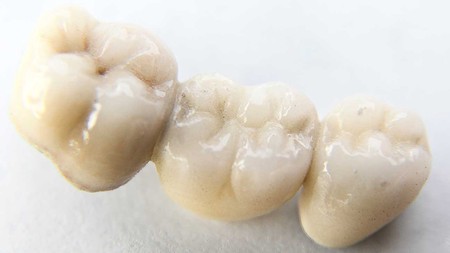 Dental Cantilever Bridges: The Good, The Bad, And The Ugly