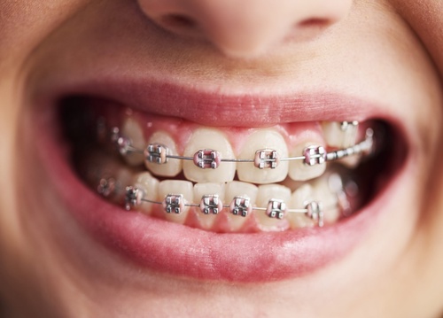 Where To Find An Orthodontist For Braces Near Me?