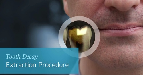 What are the Procedures involved in Tooth Extractions?