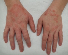 Eczema: Causes, Symptoms, Treatment and Prevention